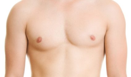 Gynecomastia