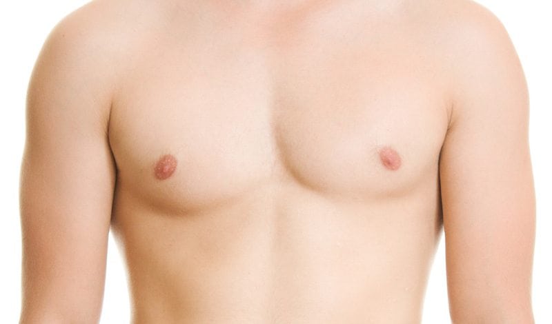 Gynecomastia