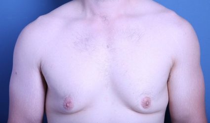 How to Get Rid of Gyno